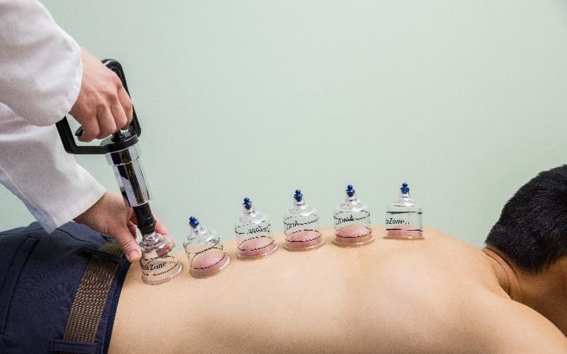 Acupuncture - Moxibustion and Cupping Therapy