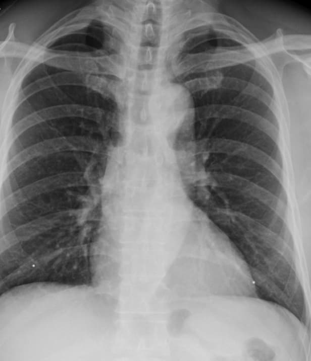 radiografía de pulmones